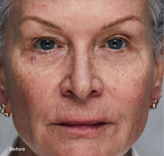 Skin Filler Serums, 